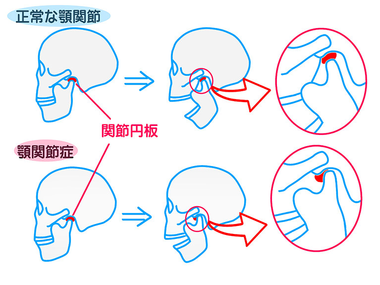 顎関節症とは